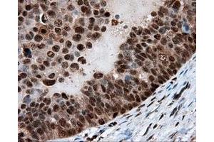 Immunohistochemical staining of paraffin-embedded Adenocarcinoma of breast tissue using anti-LTA4H mouse monoclonal antibody. (LTA4H 抗体)