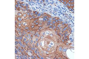 Immunohistochemistry of paraffin-embedded human esophageal cancer using BCL2L12 Rabbit mAb (ABIN7265864) at dilution of 1:100 (40x lens). (BCL2L12 抗体)