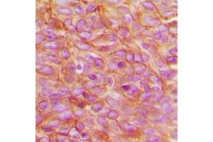 Immunohistochemical analysis of PARD3 staining in human breast cancer formalin fixed paraffin embedded tissue section. (PARD3 抗体  (C-Term))