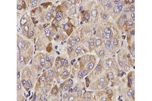 Immunohistochemistry of paraffin-embedded Human liver cancer using GAS2 Polyclonal Antibody at dilution of 1:200 (40x lens). (GAS2 抗体)