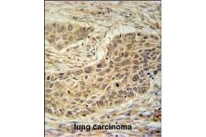 TAF1D Antibody (N-term) (ABIN651786 and ABIN2840399) immunohistochemistry analysis in formalin fixed and paraffin embedded human lung carcinoma followed by peroxidase conjugation of the secondary antibody and DAB staining. (TAF1D 抗体  (N-Term))