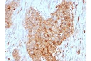 Formalin-fixed, paraffin-embedded human Breast Carcinoma stained with GPI Mouse Monoclonal Antibody (CPTC-GPI-1). (GPI 抗体)