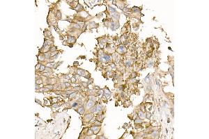 Immunohistochemistry of paraffin-embedded human lung cancer using Na+/K+-ATPase Rabbit pAb (ABIN6133568, ABIN6137299, ABIN6137301 and ABIN6223860) at dilution of 1:50 (40x lens). (ATP1A1 抗体  (AA 1-100))
