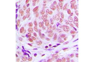 Immunohistochemical analysis of KLF11 staining in human breast cancer formalin fixed paraffin embedded tissue section.