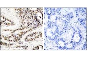 Immunohistochemistry analysis of paraffin-embedded human breast carcinoma, using CREB (Phospho-Ser129) Antibody. (CREB1 抗体  (pSer129))