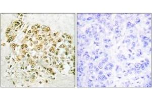 Immunohistochemistry analysis of paraffin-embedded human breast carcinoma tissue, using MZF-1 Antibody. (MZF1 抗体  (AA 1-50))
