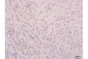 Formalin-fixed and paraffin embedded human cervical carcinoma tissue labeled with Anti CIP2A/p90 Autoantigen Polyclonal Antibody,Unconjugated (ABIN760241) at 1:200 followed by conjugation to the secondary antibody and DAB staining. (KIAA1524 抗体  (AA 601-700))
