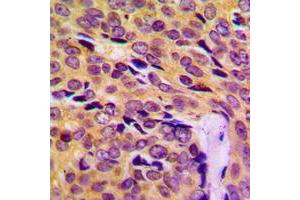 Immunohistochemical analysis of MRPL14 staining in human breast cancer formalin fixed paraffin embedded tissue section. (MRPL14 抗体  (C-Term))