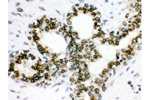 Anti- Lamin B1 Picoband antibody, IHC(P) IHC(P): Human Mammary Cancer Tissue (Lamin B1 抗体  (AA 266-583))