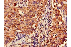 Immunohistochemistry of paraffin-embedded human lung cancer using ABIN7159021 at dilution of 1:100 (MAS1L 抗体  (AA 318-378))