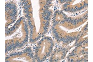 The image on the left is immunohistochemistry of paraffin-embedded Human colon cancer tissue using ABIN7190351(CRIM1 Antibody) at dilution 1/25, on the right is treated with synthetic peptide. (CRIM1 抗体)