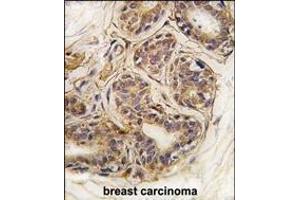 Formalin-fixed and paraffin-embedded human breast carcinoma tissue reacted with CASC3 Antibody  (ABIN391402 and ABIN2837845) , which was peroxidase-conjugated to the secondary antibody, followed by DAB staining. (CASC3 抗体  (AA 159-188))