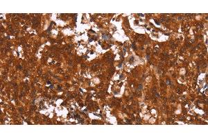 Immunohistochemistry of paraffin-embedded Human gasrtic cancer tissue using HCAR2 Polyclonal Antibody at dilution 1:40 (HCAR2 抗体)