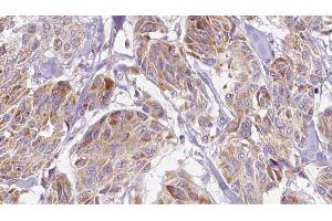 ABIN6276682 at 1/100 staining Human Melanoma tissue by IHC-P.
