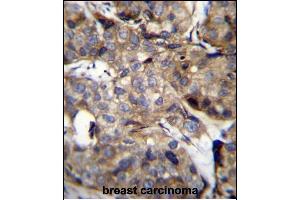 TM4SF1 Antibody (N-term) (ABIN656640 and ABIN2845885) immunohistochemistry analysis in formalin fixed and paraffin embedded human breast carcinoma followed by peroxidase conjugation of the secondary antibody and DAB staining. (TM4SF1 抗体  (N-Term))
