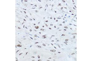 Immunohistochemistry of paraffin-embedded human esophageal cancer using SRRM1 Rabbit pAb (ABIN6133184, ABIN6148463, ABIN6148464 and ABIN6221692) at dilution of 1:450 (40x lens). (SRRM1 抗体  (AA 1-160))