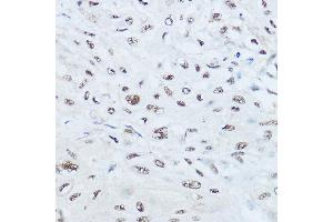 Immunohistochemistry of paraffin-embedded human esophageal cancer using SRRM1 Rabbit pAb (ABIN6133184, ABIN6148463, ABIN6148464 and ABIN6221692) at dilution of 1:450 (40x lens). (SRRM1 抗体  (AA 1-160))