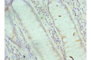 Immunohistochemistry of paraffin-embedded human colon cancer using ABIN7153696 at dilution of 1:100 (FABP6 抗体  (AA 1-128))