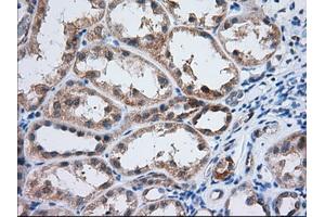 Immunohistochemical staining of paraffin-embedded Adenocarcinoma of Human ovary tissue using anti-IGF2BP2 mouse monoclonal antibody. (IGF2BP2 抗体)