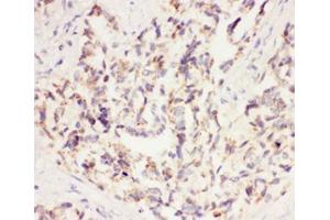 IHC-P: VEGF antibody testing of human lung cancer tissue (VEGFA 抗体  (AA 27-191))