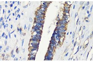 Immunohistochemistry of paraffin-embedded Human uterine cancer using FKBP1A Polyclonal Antibody at dilution of 1:200 (40x lens). (FKBP1A 抗体)