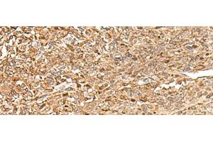 Immunohistochemistry of paraffin-embedded Human liver cancer tissue using ZC3H7A Polyclonal Antibody at dilution of 1:50(x200)