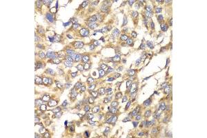 Immunohistochemistry of paraffin-embedded human esophageal cancer using VTI1B antibody (ABIN6132781, ABIN6150162, ABIN6150163 and ABIN6222854) at dilution of 1:100 (40x lens).