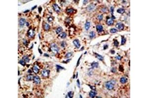 IHC analysis of FFPE human hepatocarcinoma tissue stained with the KMT4 antibody (DOT1L 抗体  (AA 1390-1420))