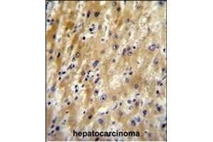 HABP2 Antibody (C-term) (ABIN651853 and ABIN2840423) immunohistochemistry analysis in formalin fixed and paraffin embedded human hepatocarcinoma followed by peroxidase conjugation of the secondary antibody and DAB staining. (HABP2 抗体  (C-Term))