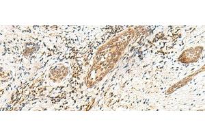 Immunohistochemistry of paraffin-embedded Human esophagus cancer tissue using POLR1D Polyclonal Antibody at dilution of 1:50(x200) (POLR1D 抗体)