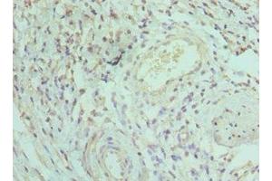 Immunohistochemistry of paraffin-embedded human epityphlon tissue using ABIN7156750 at dilution of 1:100 (IRAK3 抗体  (AA 367-596))