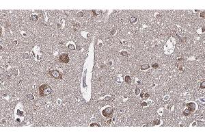 ABIN6277649 at 1/100 staining Human brain cancer tissue by IHC-P. (WNK3 抗体  (C-Term))