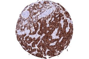 Pancreatic neuroendocrine tumor insulinoma with strong Insulin positivity of most tumor cells (Recombinant Insulin 抗体)