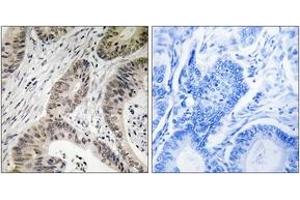 Immunohistochemistry analysis of paraffin-embedded human colon carcinoma, using TUT1 Antibody. (TUT1 抗体  (AA 291-340))