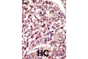 Formalin-fixed and paraffin-embedded human cancer tissue reacted with the primary antibody, which was peroxidase-conjugated to the secondary antibody, followed by AEC staining. (MGAT1 抗体  (C-Term))