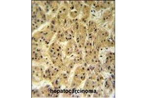 SC24A Antibody (Center) (ABIN650899 and ABIN2839987) IHC analysis in formalin fixed and paraffin embedded hepatocarcinoma followed by peroxidase conjugation of the secondary antibody and DAB staining. (SEC24A 抗体  (AA 636-663))