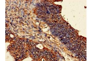 Immunohistochemistry of paraffin-embedded human colon cancer using ABIN7162297 at dilution of 1:100 (ODC1 抗体  (AA 1-461))