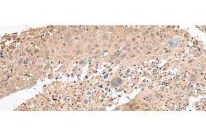 Immunohistochemistry of paraffin-embedded Human cervical cancer tissue using PATJ Polyclonal Antibody at dilution of 1:45(x200) (PATJ 抗体)