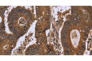 Immunohistochemistry of paraffin-embedded Human colon cancer using FGFRL1 Polyclonal Antibody at dilution of 1:40 (FGFRL1 抗体)