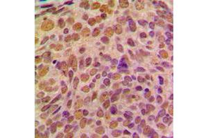 Immunohistochemical analysis of Cyclin B1 staining in human breast cancer formalin fixed paraffin embedded tissue section.
