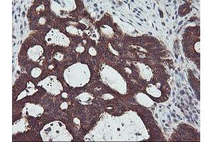 Immunohistochemical staining of paraffin-embedded Adenocarcinoma of Human colon tissue using anti-PDRG1 mouse monoclonal antibody. (PDRG1 抗体)