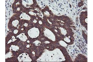 Immunohistochemical staining of paraffin-embedded Adenocarcinoma of Human colon tissue using anti-PDRG1 mouse monoclonal antibody.
