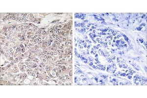 Peptide - +Immunohistochemistry analysis of paraffin-embedded human breast carcinoma tissue using GPRIN3 antibody. (GPRIN3 抗体  (Internal Region))