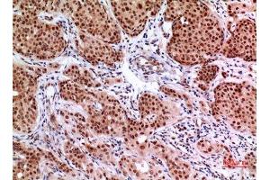 Immunohistochemistry (IHC) analysis of paraffin-embedded Human Mammary Cancer, antibody was diluted at 1:100. (EPAS1 抗体  (Ser343))