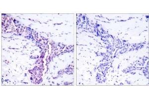 Immunohistochemical analysis of paraffin-embedded human breast carcinoma tissue using ATF-2 (Ab-73 or 55) antibody (E021032). (ATF2 抗体)