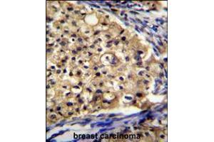 SLC16A13 Antibody immunohistochemistry analysis in formalin fixed and paraffin embedded human breast carcinoma followed by peroxidase conjugation of the secondary antibody and DAB staining. (SLC16A13 抗体  (C-Term))