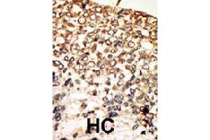 Formalin-fixed and paraffin-embedded human hepatocellular carcinoma tissue reacted with PRKACA polyclonal antibody  , which was peroxidase-conjugated to the secondary antibody, followed by AEC staining . (PRKACA 抗体  (N-Term))
