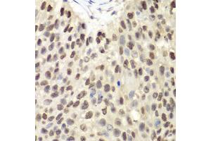 Immunohistochemistry of paraffin-embedded human lung cancer using MCM6 antibody. (MCM6 抗体)