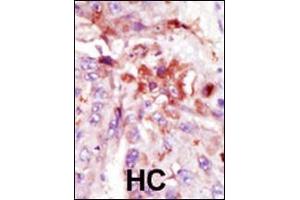 Formalin-fixed and paraffin-embedded human cancer tissue reacted with the primary antibody, which was peroxidase-conjugated to the secondary antibody, followed by AEC staining.