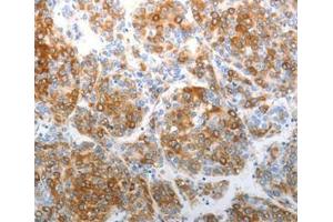 Immunohistochemical analysis of paraffin-embedded Human tonsil cancer tissue using at dilution 1/40. (CHD5 抗体  (C-Term))